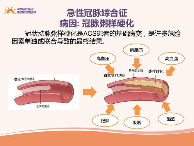 急性冠脉综合征疾病知识及生活防治措施.ppt