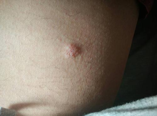 我在大腿内侧出现这个是不是 硬下疳谢谢
