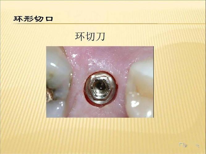 种植牙二期修复