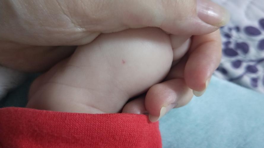 今天突然在宝宝脚上看到这个,是不是白血病出血点啊,好害怕