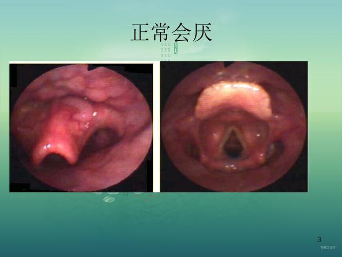 急性会厌炎的护理ppt参考幻灯片