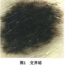 nevus)  中老年人多见,表现为平坦或高出皮面,或呈疣状或有蒂状,直径