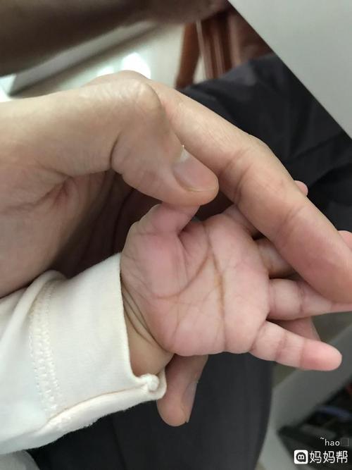 我宝宝双手断掌,会是唐氏儿吗?