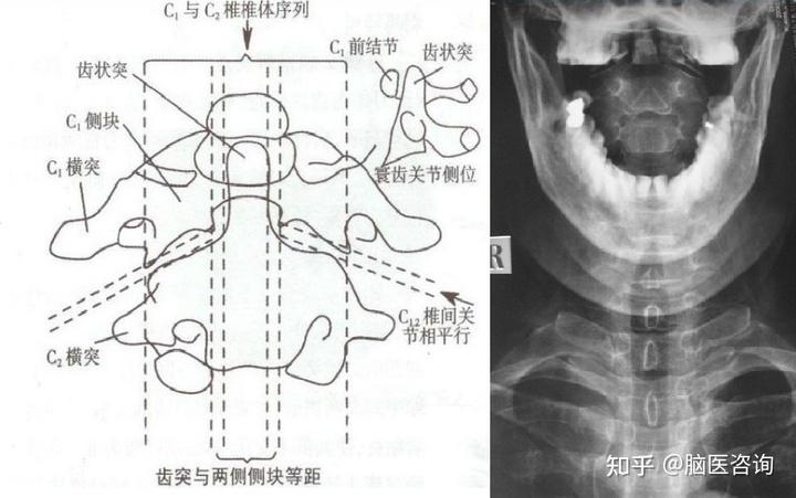 颈椎正侧位不易于观察寰,枢椎情况,通过张口位拍片,可以观察寰,枢椎有