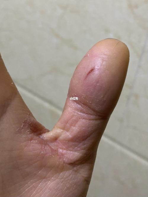 手指头开裂,反复发作!谁知道啥情况_医疗健康_医疗健康其他