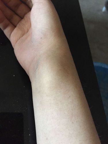 关于身体健康方面的,手掌与手腕处长了个包,上网查觉得像腱鞘炎,但