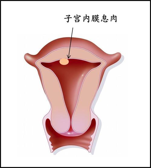 同样是子宫内膜息肉,为什么处理却不同?