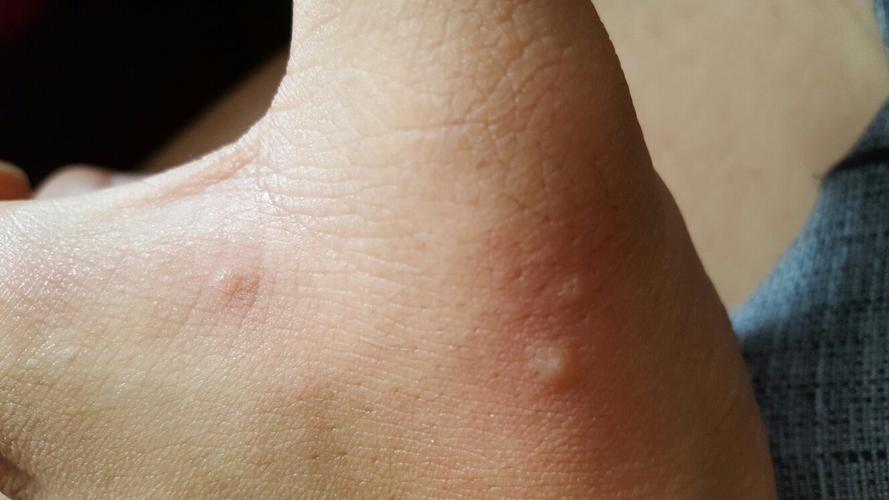 这是不是干疮子?很小的,透明的