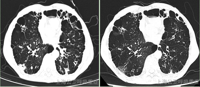 两肺肺气肿,胸膜下多发结节 中央小空洞,会是什么病原体?