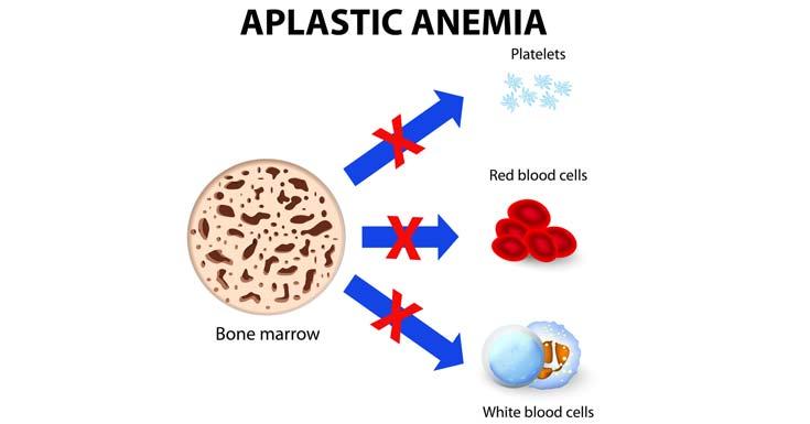 aplastic-anemia