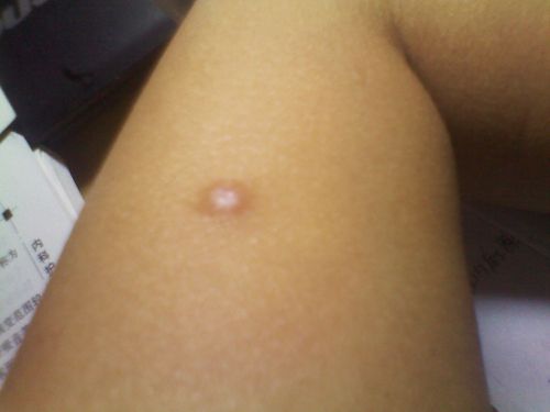 (校医曾说是纤维瘤)长了一年来不痛不痒,近日来经常搔痒难耐啊