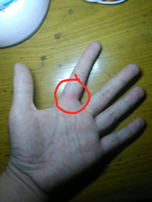 腱鞘囊肿对手指活动有什么影响.在手指关节处有个黄豆粒大小的硬疙瘩.