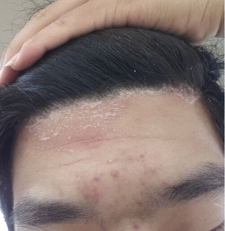 头廯和脂溢性皮炎的区别