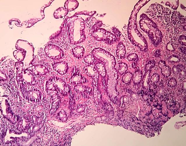 常见病的病理诊断(一)——慢性萎缩性胃炎