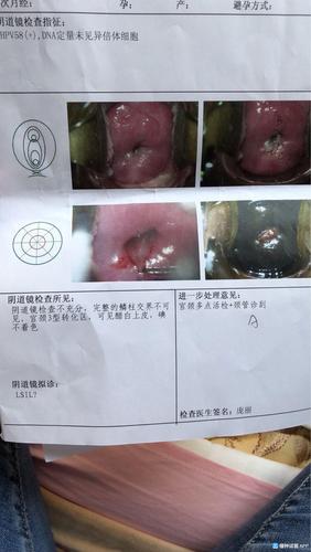 [试管婴儿]有没有知道hpv58阳性大夫建