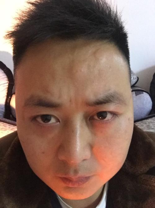 我额头上最近长出一个包.不痛不痒像骨头很硬怎么回事