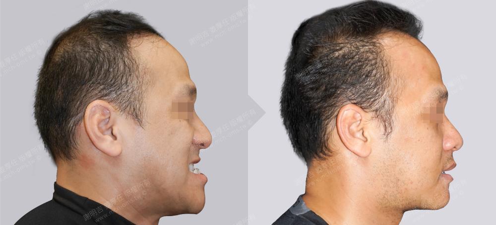 如何判断是骨性地包天还是牙性地包天,如何矫正