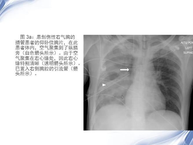气胸的x线表现.pptx