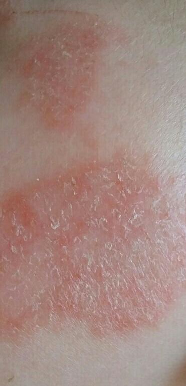 医生婴儿湿疹,用金银花洗过之后有脱皮现象是好转还是