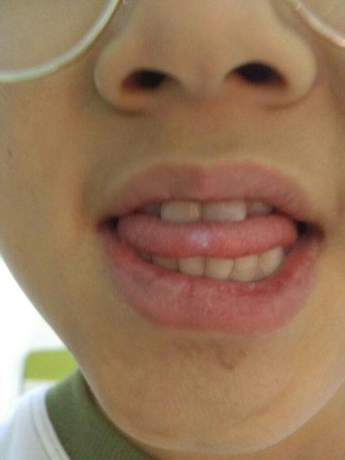 舌头上有白斑,白斑不疼.旁边还有小白点,白点有点痒.是怎么回事.