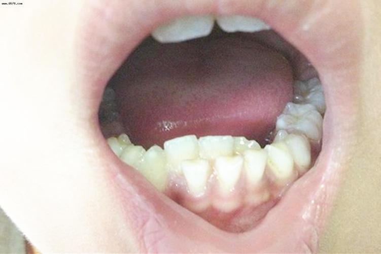 宝宝长出吓人的双排牙,只因宝妈准备饮食时,多做了一件事