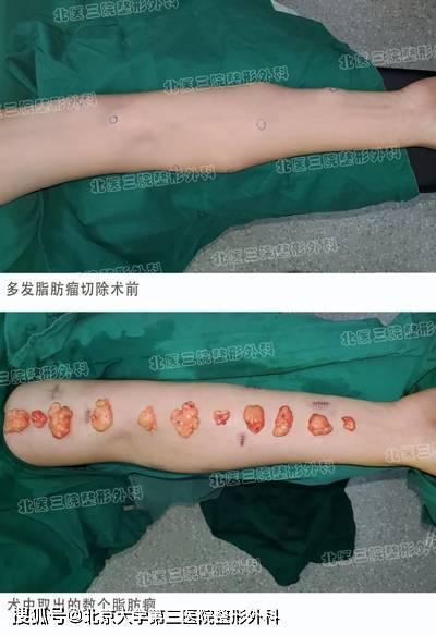 医生,我身上长了几十个脂肪瘤怎么办?_手术_影响_部位