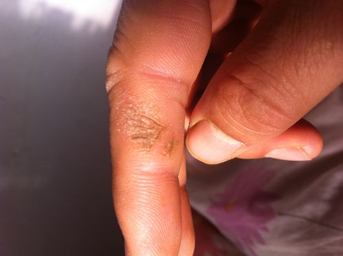 手指角质化开裂三根手指上都有其中右手食指第二关节面积较