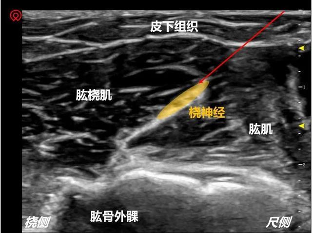 瑞金专题超声引导下桡神经阻滞