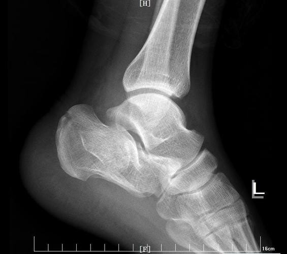 跟骨粉碎性骨折手术治疗