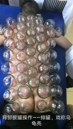 背部拔罐操作——排罐,戏称乌龟壳