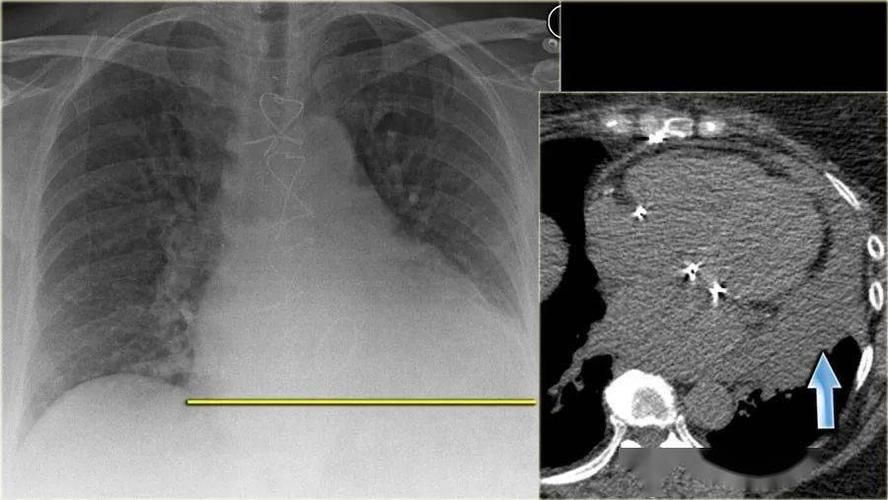 胸片心力衰竭