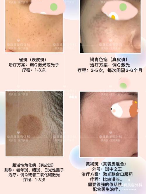 你脸上的斑是什么斑?