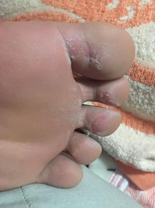 请问怎么治疗?脚底走路会痛,脚趾缝里痒