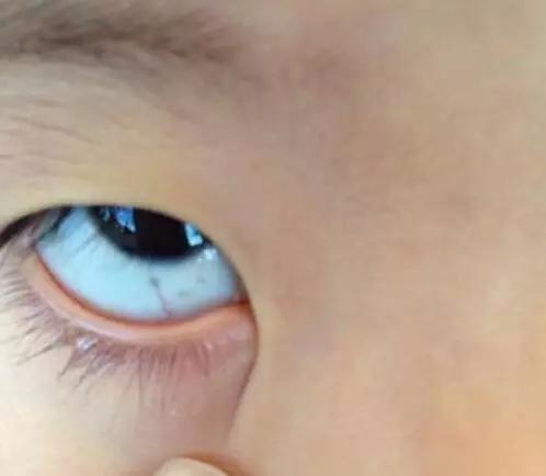 眼白出现这几种颜色 你该警惕了!