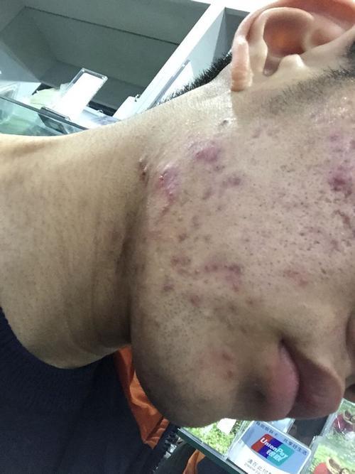 帝宁denim带你了解痤疮,痘痘的区别.