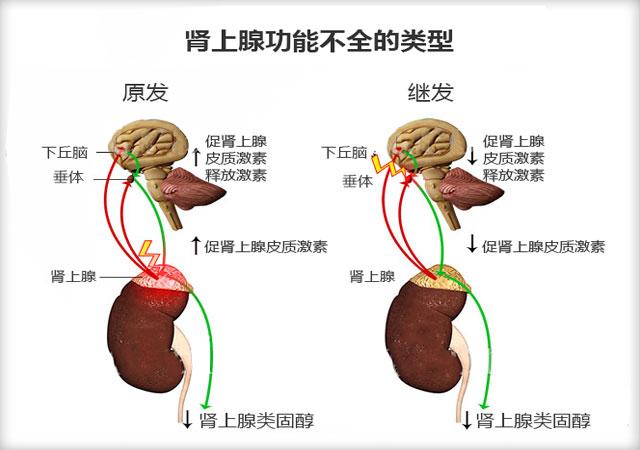 什么是肾上腺功能不全及分类症状原因治疗方法