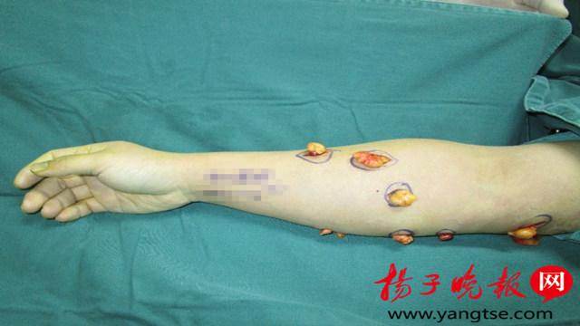 一男子两只胳膊上居然长了26个脂肪瘤