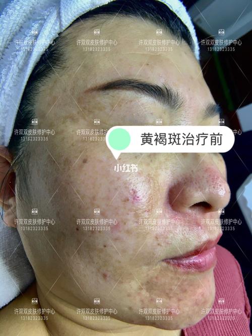 黄褐斑治疗4次对比_黄褐斑_美妆_护肤_护肤其他