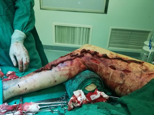 下肢浅静脉曲张 伴血栓形成 手术行静脉曲张剥脱术以及血栓切除治疗