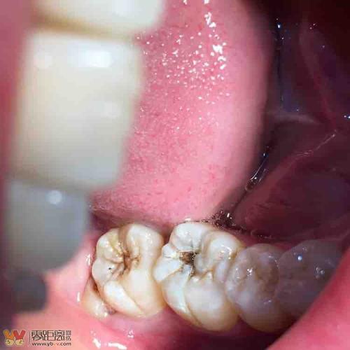 牙齿上面这种黑色的需要补吗