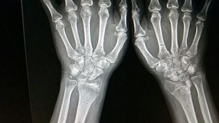 双手腕关节桡骨粉碎性骨折,做了外固定架手术,(固定架已拆除)现术后80