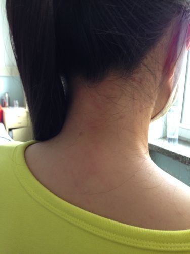 脖子两边长疙瘩,后面正中明显有个包怎么回