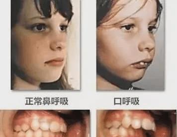 腺样体面容的人缺乏面部表情,看起来会有点呆,具体还有以下3个特点