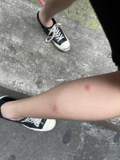 被蚊子咬的腿都肿了 有什么止痒药吗 求推荐_止痒_医疗健康_医疗健康