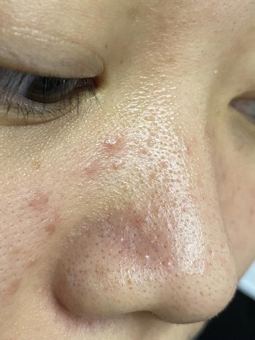 这鼻子都是黑头毛周角化还有救吗!毛孔也太_痘痘_闭口