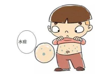 原创宝宝突发水痘,家长们要随时做好"战痘"准备!