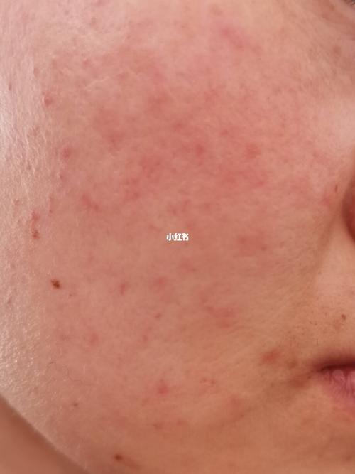 脸,一直以为护肤品过敏,医生说脂溢性皮炎和玫瑰痤疮_痤疮_化妆_护肤