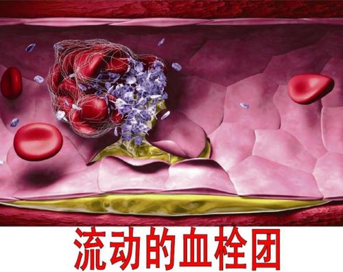 "血栓"的症状有哪些?若日常生活中注意这2点,或对你有