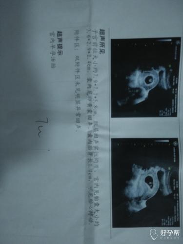 大夫说,一切正常,胎儿大小正好,很开心,希望宝宝健康成长,过一月可以