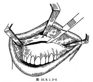 作上颌前庭沟横形切口.